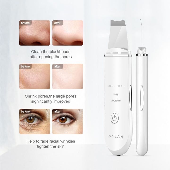 Ultrasonic Skin Lift Machine